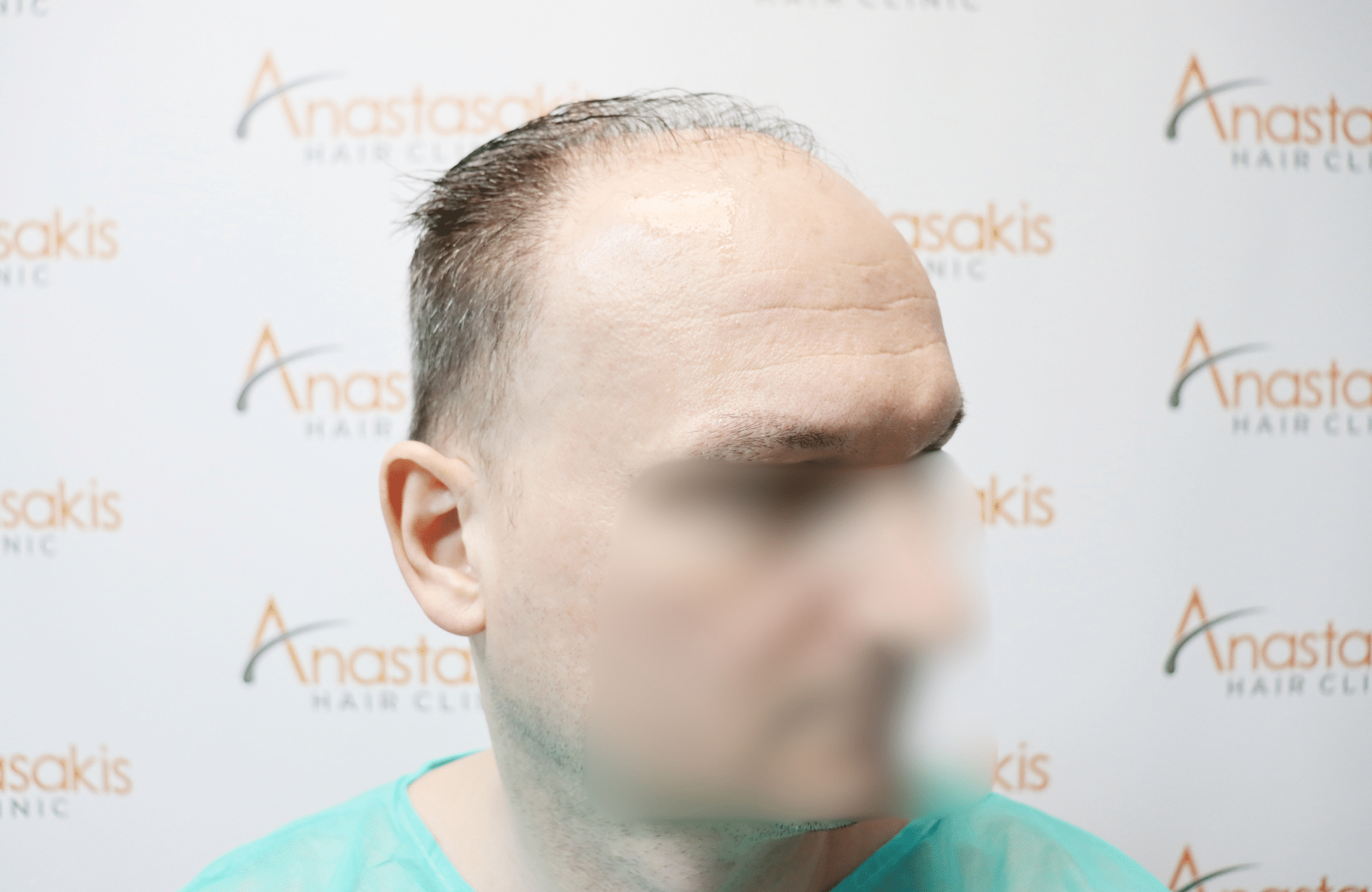 hair tranplant result (6)