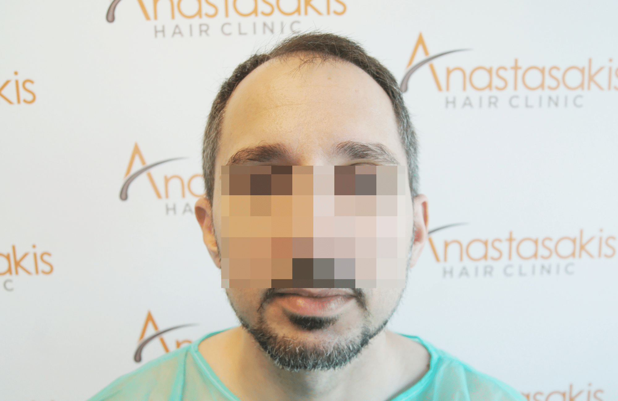 hair transplant result by anastasakis hair clinic 2500 fus