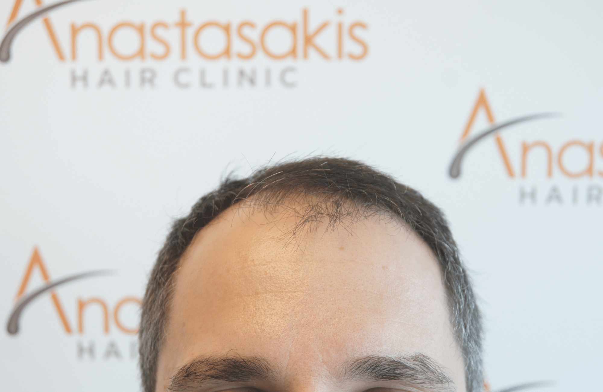 hair transplant result by anastasakis hair clinic 2500 fus