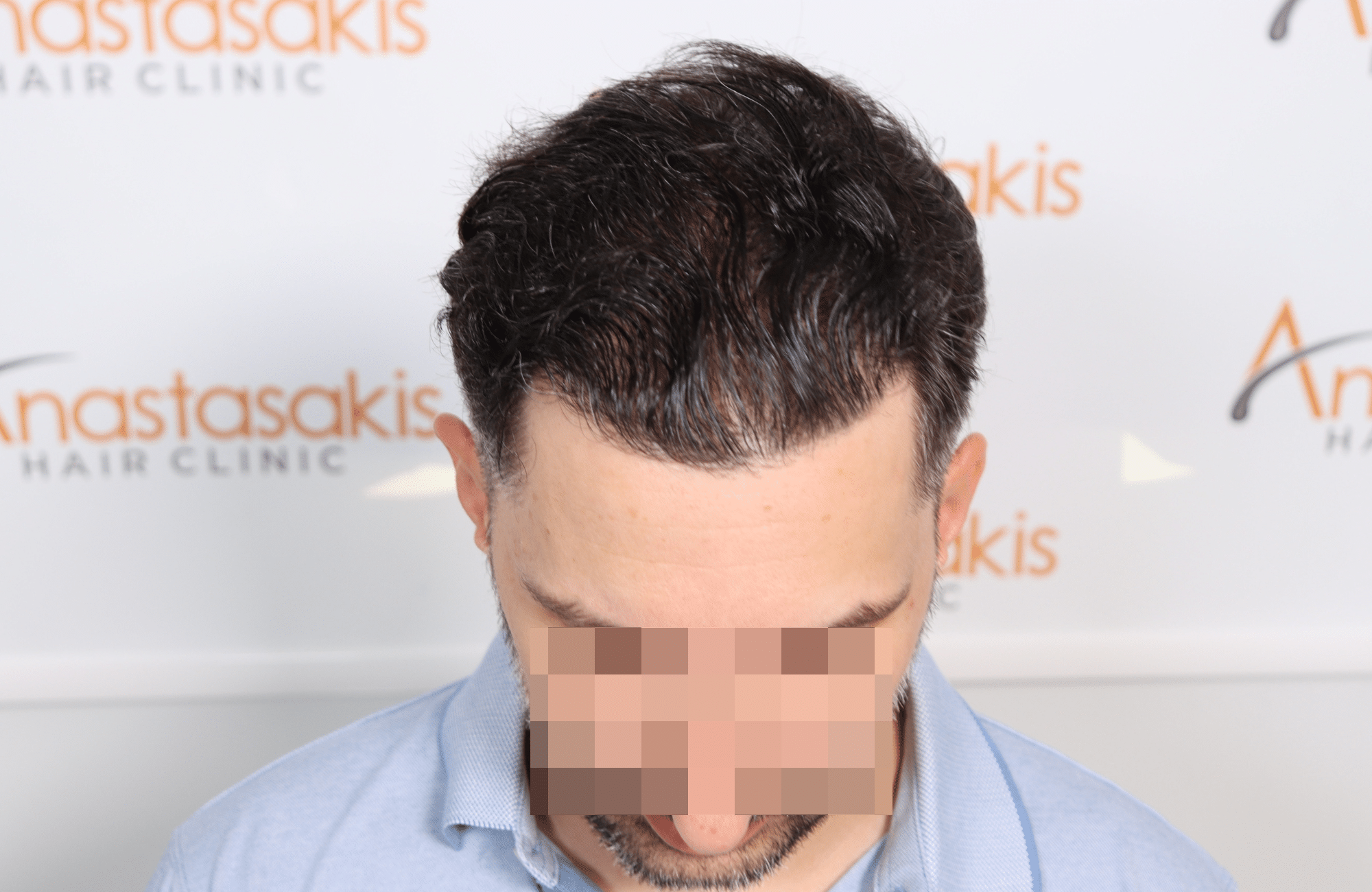 hair transplant result by anastasakis hair clinic 2500 fus