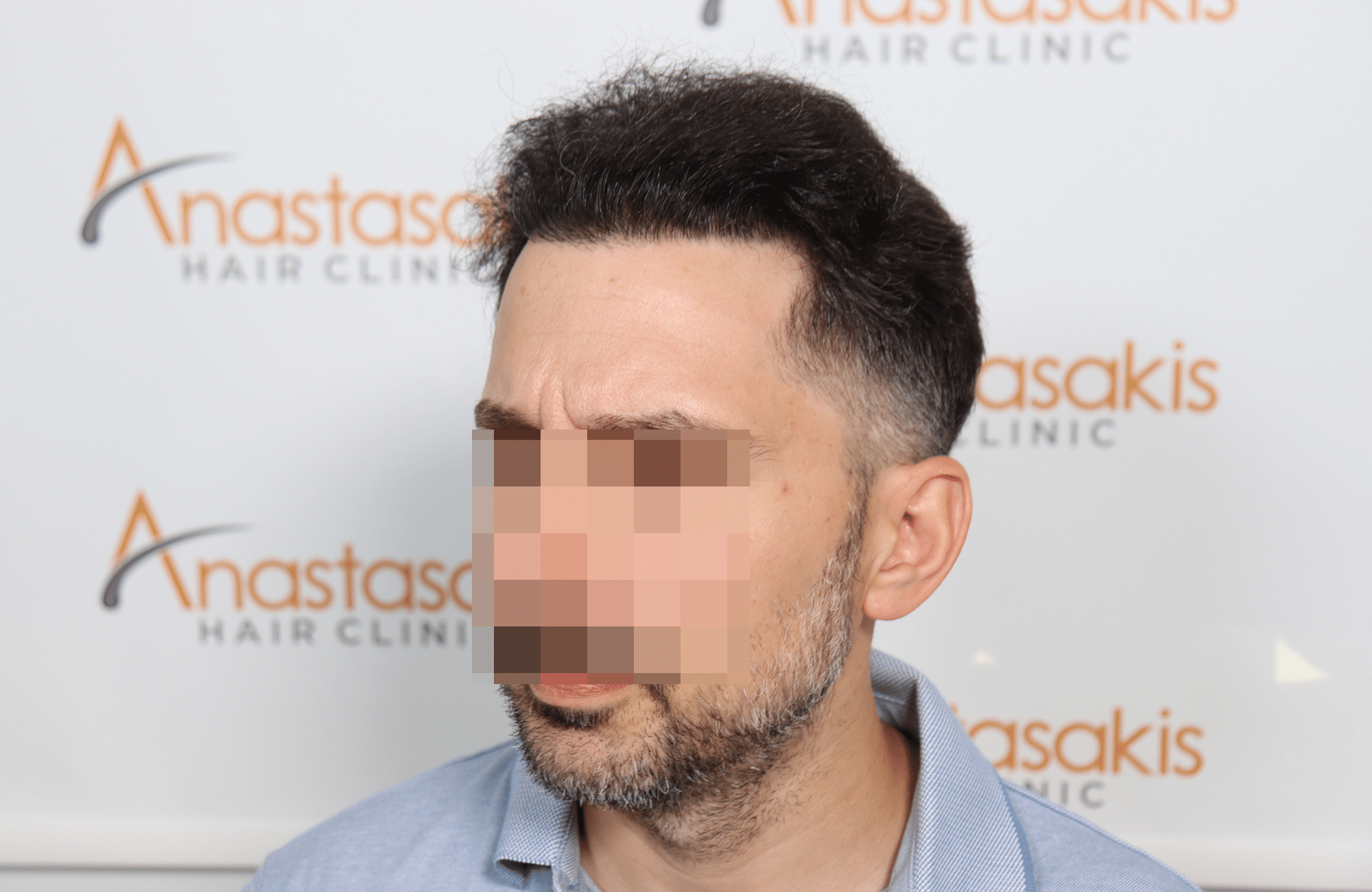 hair transplant result by anastasakis hair clinic 2500 fus