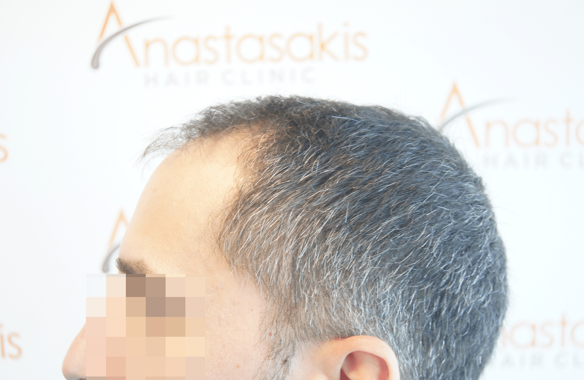 hair transplant result by anastasakis hair clinic 2500 fus