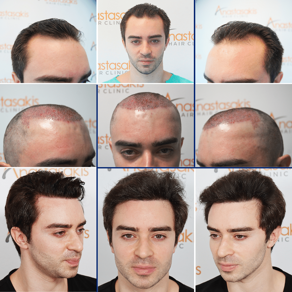 Hair Transplantation Results – Before and After Photos
