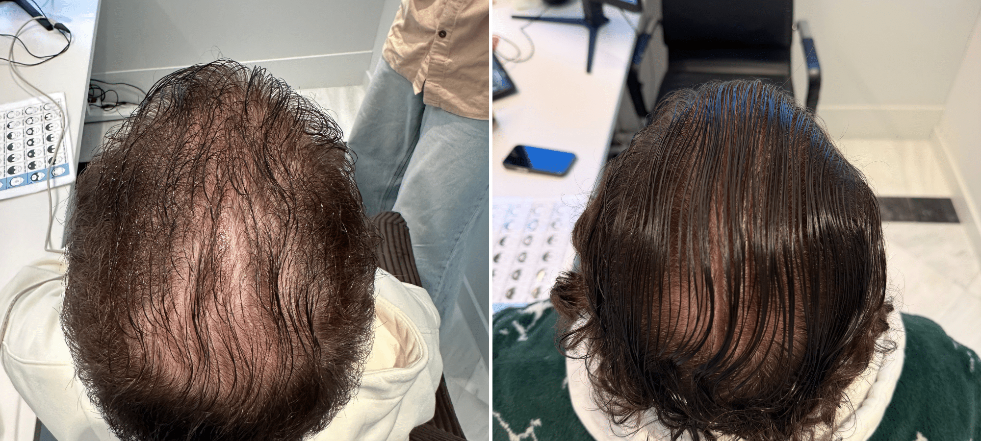 26 years mino 2,5g 6 months