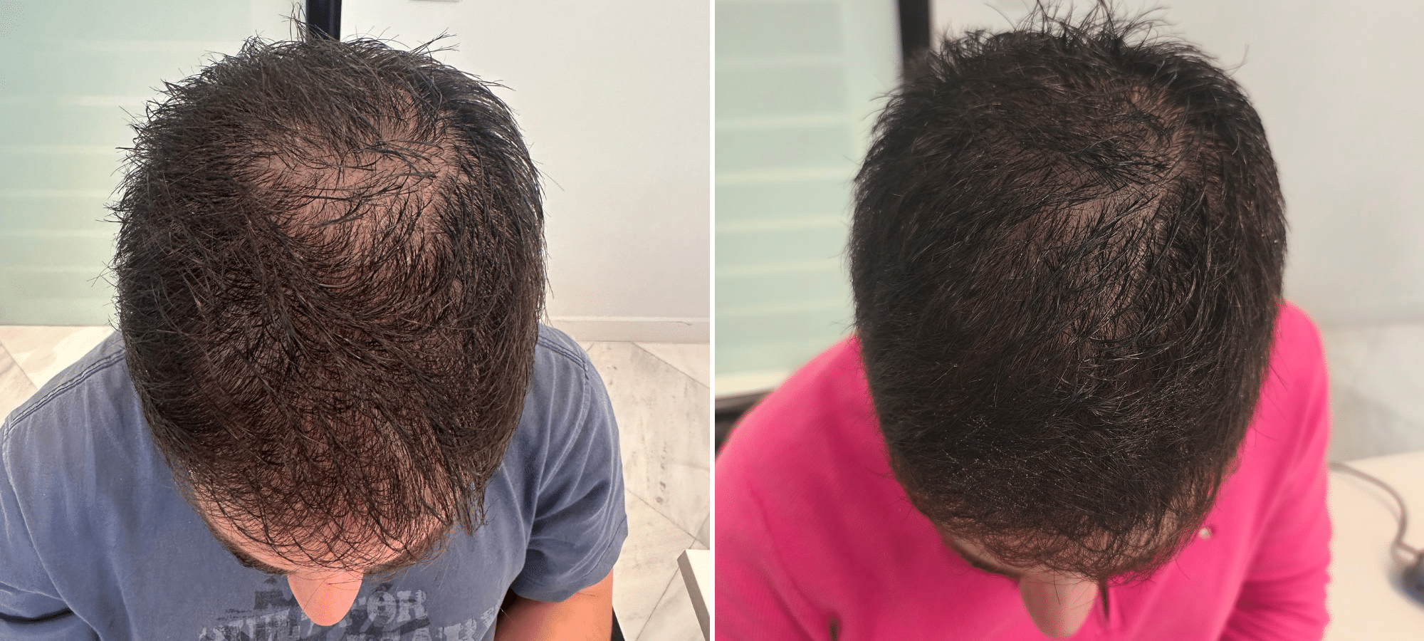 A 34-year-old man with thin, weak hair at the crown followed treatment with minoxidil and finasteride. In the photo on the right, you can see his result 6 months after starting the treatment.