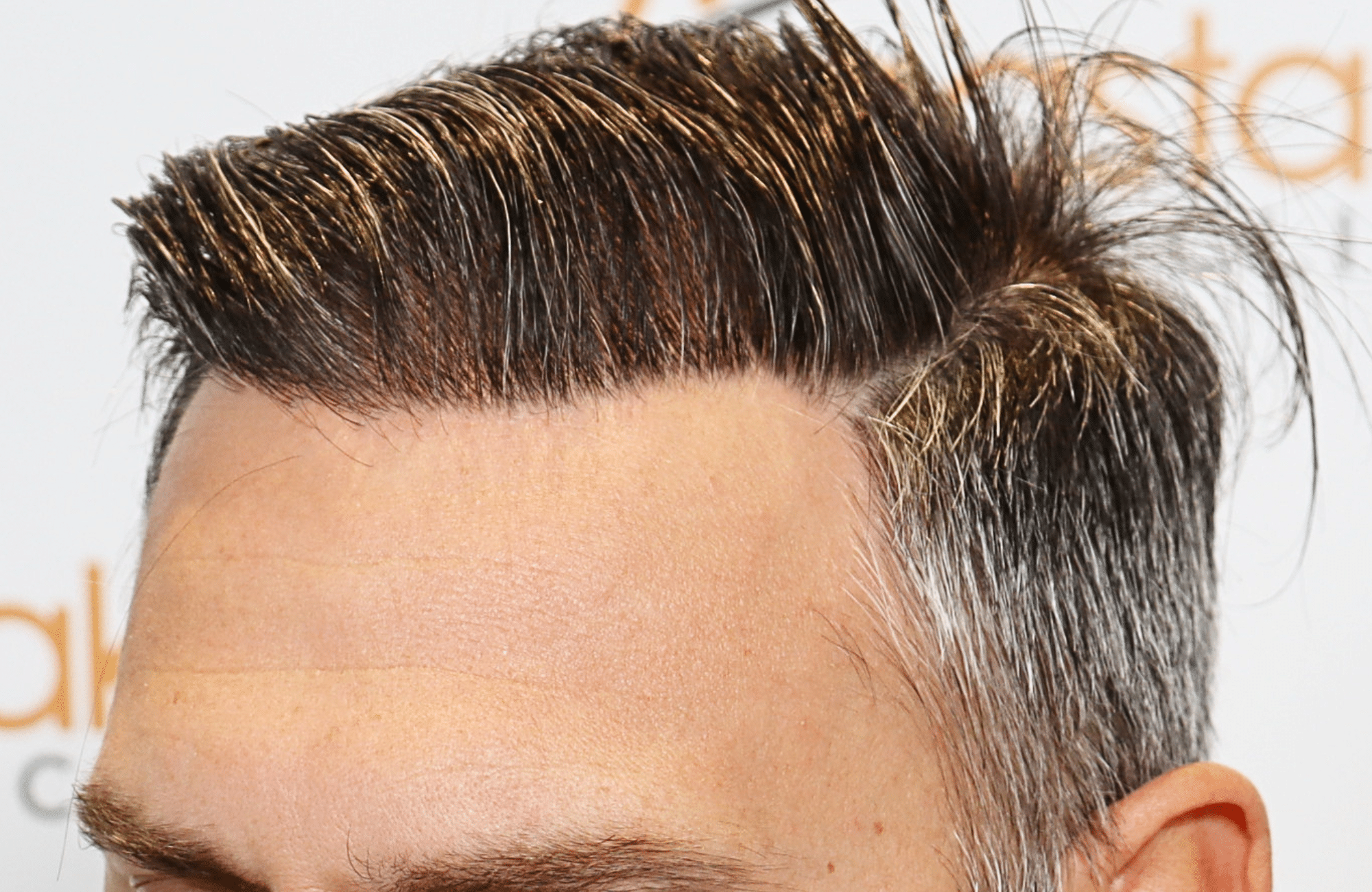 hair transplant result 3500 fus thick 1st stage