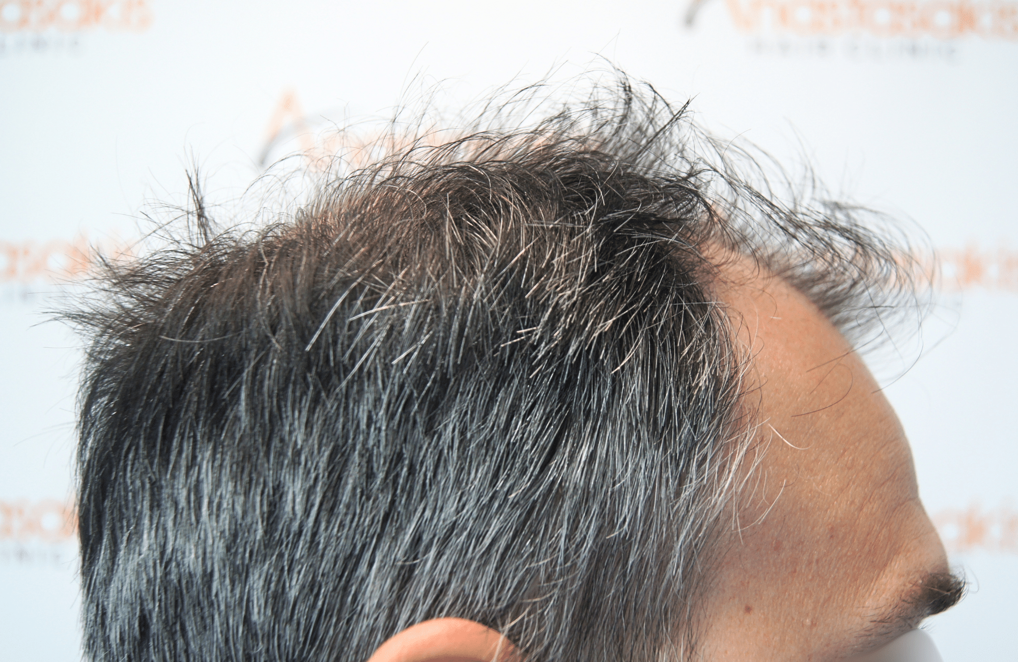 hair transplant result 3500 fus thick 1st stage