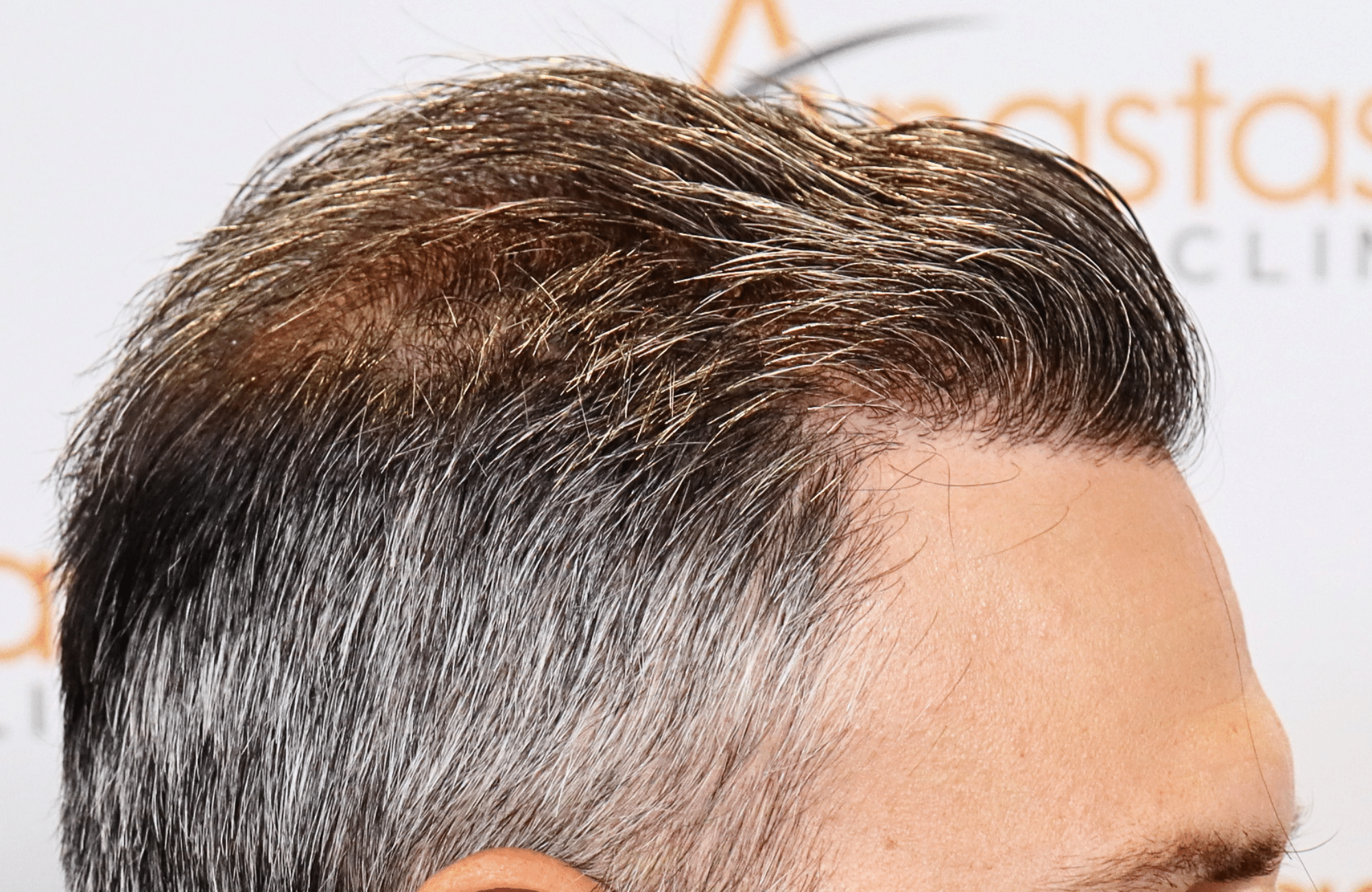 hair transplant result 3500 fus thick 1st stage
