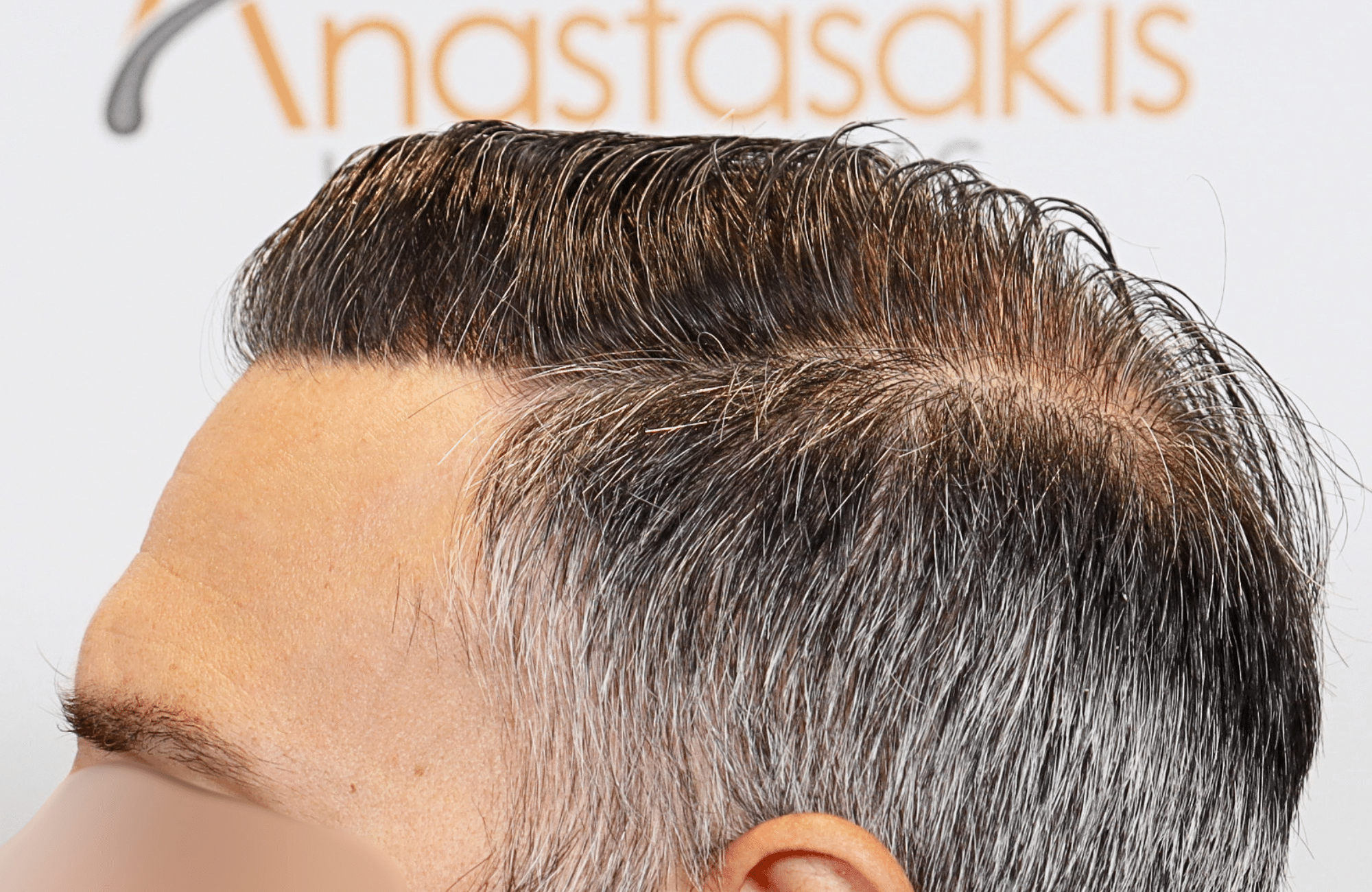 hair transplant result 3500 fus thick 1st stage